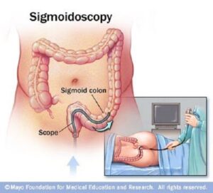 Sigmoidoscopy