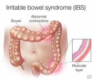 Irritable Bowel Syndrome(IBS)