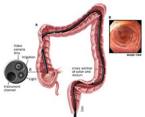 Endoscopic Ultrasound(EUS)