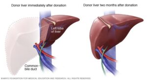 Liver Transplantation