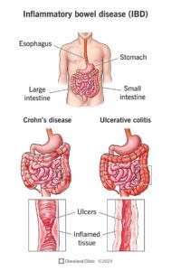 IInflammatory bowel disease (IBD)