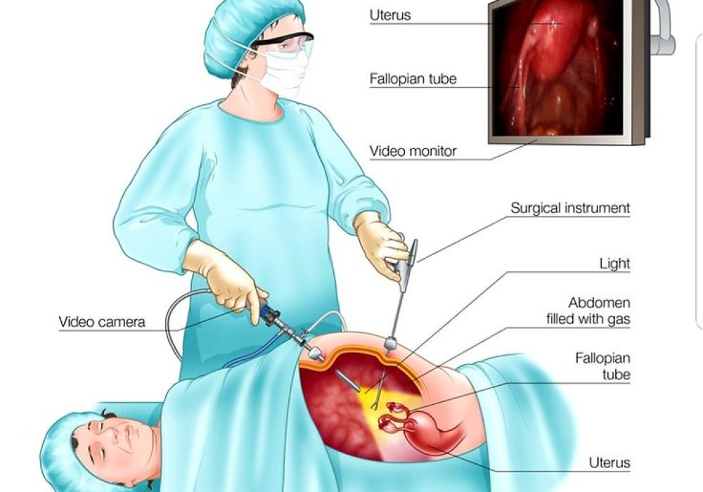 Endometriosis Surgery