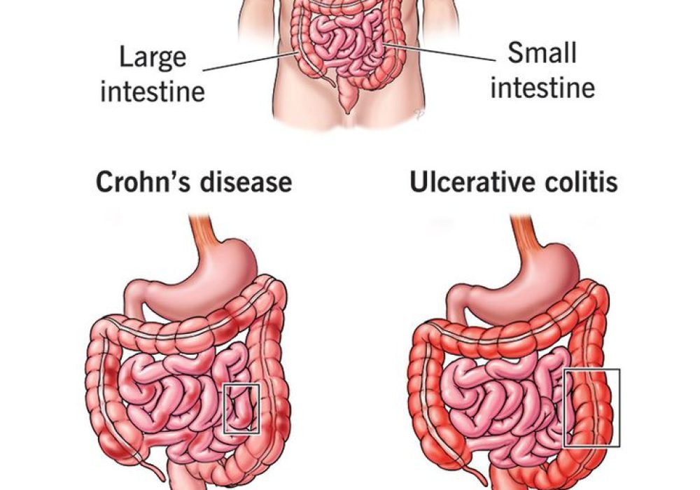 What Is Inflammatory Bowel Disease (IBD)? What Is Inflammatory Bowel Disease (IBD)?