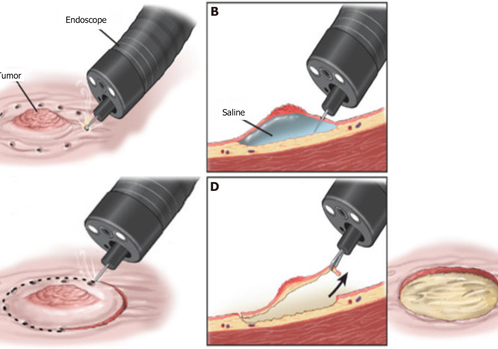 third space endoscopy pic